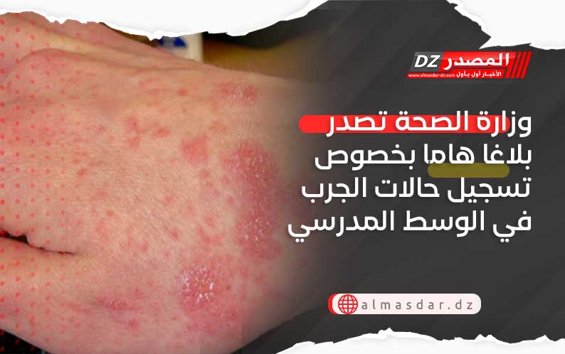 وزارة الصحة تصدر بلاغا هاما بخصوص تسجيل حالات الجرب في الوسط المدرسي